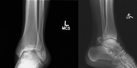 Preoperative AP and lateral radiographs four ossified loose bodies in the posterior ankle.