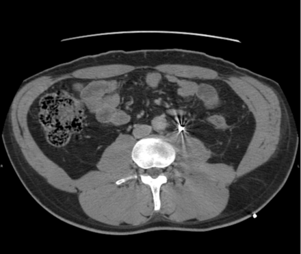 First CT scan demonstrating Onyx in the left ureter.