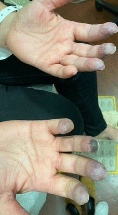 Purplish discolouration of fingers of both hands, with a necrotic/gangrenous area on the distal part of fourth digit of the right hand.