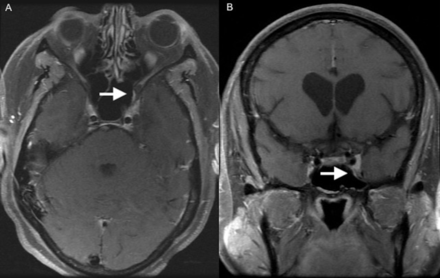 Lesion identified by the white arrow on T1-weighted postgadolinium-based contrast axial (A) and coronal (B) MRI of the brain and orbits showing hyperintense enhancing convexity protruding from the medial wall of the left cavernous sinus.