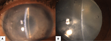 (A) Slit-lamp photograph reveals corneal oedema, fibrinous reaction in anterior chamber with 360° peripheral anterior synechia and aphakia in the right eye and (B) intumescent cataract with phakic intraocular lens lenticular touch in the left eye.