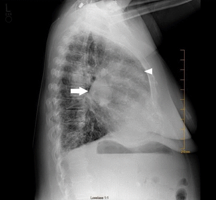 Chest radiograph (lateral view) shows dilated pulmonary artery and right ventricular enlargement.