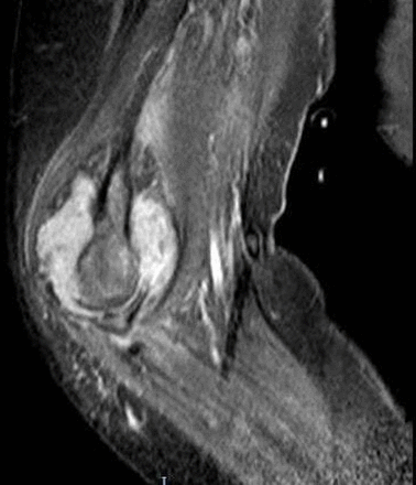 MRI of right elbow without contrast: gross elbow joint capsular distension with a heterogeneous intra-articular fluid component. Fat saturation and short-tau inversion recovery sequences show high intensity signal involving the bone marrow compartment of the proximal radius and ulna in which the presence of a possible underlying bone marrow oedematous process.
