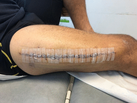 Right anterior thigh when discharged from hospital.