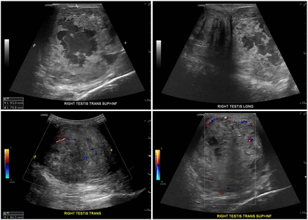 Ultrasound images of the patient’s right testicle demonstrating the testicular masses with central cystic components, which replaced normal testicular parenchyma.