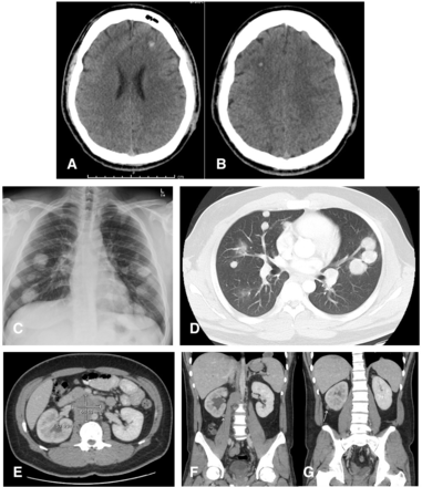 (A-B) Axial cross-sectional CT images demonstrating bilateral frontal lobe lesion, representing metastatic deposits; (C) chest X-ray (CXR) image showing cannon-ball metastases appearance; (D) axial cross-sectional CT image with circular hyperdense bilateral lesions within lung parenchyma; (E) axial cross-sectional CT image showing a 60.5×57.9 cm retroperitoneal mass; (F-G) coronal cross-sectional CT images with arrows pointing at perinephric metastatic deposits, more noted on the right.