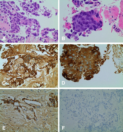 (A) H&E stain of sample obtained from percutaneous testicular biopsy (x400); (B) H&E stain of the tumour sample (x200); (C-D) immunostaining of the sample positive for human chorionic gonadotrophin (hCG) with features consistent with choriocarcinoma (x400); (E) immunostaining showing positivity for alpha-fetoprotein (AFP) (x400) and (F) negative for CD30 (x200).