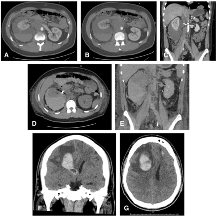 (A-B) Axial cross-sectional CT images of the abdomen demonstrating active development of the right perinephric haematoma; (C) coronal cross-sectional CT image highlighting the size of the right perinephric haematoma; (D-E) axial and coronal cross-sectional images of the repeat CT due to concerns for ongoing perinephric bleed; (F-G) axial and coronal cross-sectional CT brain images demonstrating progression of intracranial metastases now with mass effects.