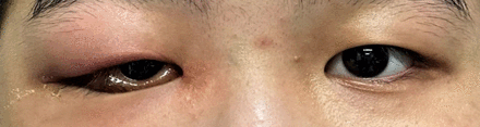Macroscopic photograph of both eyes. Right upper lid ptosis, erythema and oedema, with associated conjunctival injection and chemosis.