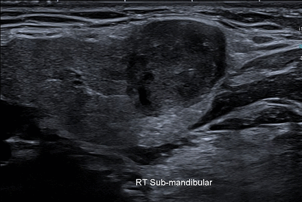 Well-defined hypoechoic mass in the right submandibular gland without significant internal vascularity on ultrasound neck which was later histologically diagnosed as nodular fasciitis.