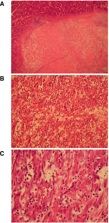 Histologic images of the specimen from right submandibular gland excision. (A) 20x magnification of the specimen showing the submandibular gland and the lesion (nodular fasciitis tumour). (B) 40x magnification of the nodular fasciitis tumour showing fibroblastic–myofibroblastic proliferation with tissue culture-like/storiform growth pattern. (C) 80x magnification of the nodular fasciitis tumour showing the spindle-shaped fibroblasts–myofibroblasts and interspersed lymphocytes. No cellular atypia or increased mitotic activity is present.