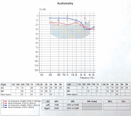 Baseline audiogram prior to initiation of teprotumumab demonstrates mild hearing loss at 4000–8000 Hz, otherwise normal hearing threshold at 250–3000 Hz bilaterally. The right ear is slightly worse than the left ear by 10 dB at 250–1000 Hz.