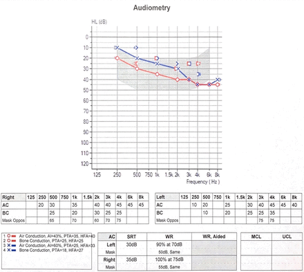 Audiogram after the fifth dose of teprotumumab demonstrates bilateral mild to moderate-severe down sloping sensorineural hearing loss with a 15–30 dB decline at 500–8000 Hz compared with baseline.