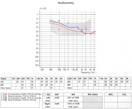 Audiogram 6 weeks after cessation of teprotumumab shows no change from her audiogram after the fifth dose.