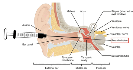 Schematic of intratympanic membrane injection to the round window. Modified and printed with permission from OpenStax Anatomy and Physiology. https://openstax.org/books/anatomy-and-physiology/pages/preface, https://creativecommons.org/licenses/by/4.0/deed.en