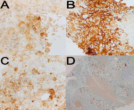 Mediastinal tumour biopsy immunohistochemistry. (A) Focal positivity for human chorionic gonadotropin (200×). (B) Diffuse positivity for cytokeratin 7 (200×). (C) Focal positivity for placental-like alkaline phosphatase (200×). (D) Focal positivity for tumour protein p63 (100×).
