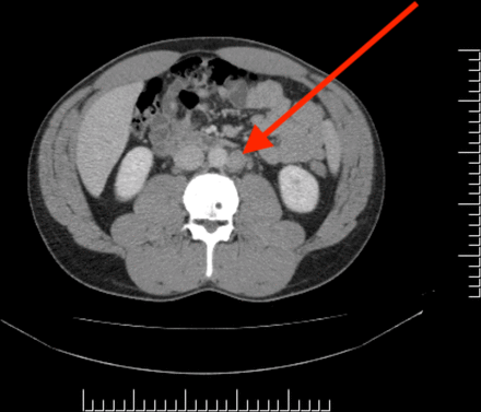 CT showing an enlarged fatty appearing para-aortic retroperitoneal lymph node measuring 18 mm at initial diagnosis (red arrow).