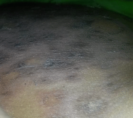At some areas, the lesions were necrotic dark patches.