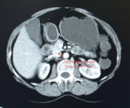 CT finding of lesion: 1.4×1.2 × 1.1 cm lesion posterosuperior aspect of head of pancreas.