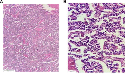 Histopathology findings. (A) Picture showing a typical low-grade endocrine pattern of tumour. Well-formed cords and trabeculae of tumour cells surrounded by thin or compressed vascular spaces. (B) High power pictures showing monotonous cells with minimal nuclear anaplasia and abundant cytoplasm. Mitotic figures are conspicuously absent.