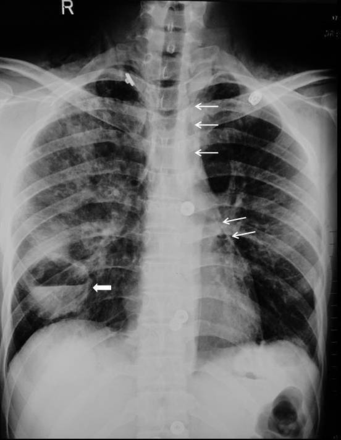 Frontal chest radiograph shows a well-defined, thin-walled cavity with air-fluid level in the right lower zone (thick white arrow). Patchy areas of airspace opacification are seen surrounding the cavity suggestive of contusions. Pneumomediastinum is seen (thin white arrows).