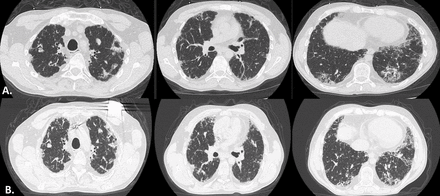 (A) Chest CT of the patient receiving MMF plus corticosteroids for ILD as a complication for Fanconi syndrome showing bilateral consolidations, traction bronchiectasis and fine reticulation of subpleural distribution. (B) Radiologic progression 12 months after MMF discontinuation. ILD, interstitial lung disease; MMF, mycophenolate mofetil.