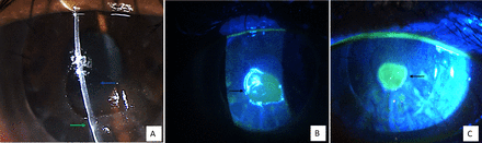 Slit lamp photographs of the patient with neurotrophic keratitis in the donor corneal graft showing (A) central 4×3.5 mm punched-out epithelial defect in the central cornea (blue arrow) with epithelial heaping at the margins of the defect (green arrow). Cobalt blue filter with fluorescein stain (B) enhances the epithelial defect (black arrow) and demonstrates the sharp borders. The epithelial defect (black arrow) decreased in size (C) after a week of therapy and removal of the inciting drug, bromfenac eyedrops, delineated clearly with fluorescein staining visualised under cobalt blue filter.