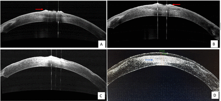 Serial anterior segment optical coherence tomography (ASOCT) images of the left eye taken at 1 week interval showing course of healing of the persistent epithelial defect. Note the denudation of corneal epithelium centrally (A) with heaped up margins (red arrow) at the time of presentation. Reduction in size of defect (B) was noted at follow-up visits followed by complete healing of the defect (C) along with irregular epithelial surface and underlying stromal inflammation. At the completion of 4 weeks, a residual macular corneal opacity (D) involving the anterior stromal layers (blue arrow) and relative sparing of the posterior stromal layers was noted.