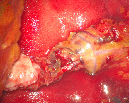 Primary end-to-end anastomosis of previously divided DIEA. DIEA, deep inferior epigastric artery.