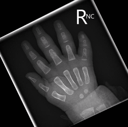 X-ray of right hand at presentation demonstrating rarefaction and periosteal reaction in the third, fourth and fifth middle phalanges, distal fourth phalanx, proximal third and fifth phalanges. Associated cortical punched out metaphyseal lesions and swelling of the overlying soft tissues are evident.