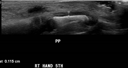 Ultrasound image showing hypoechoic thickened periosteum over the fifth proximal phalanx (PP).