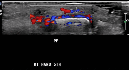 Colour Doppler ultrasound image showing hyperaemia of the periosteum of the fifth proximal phalynx (PP).