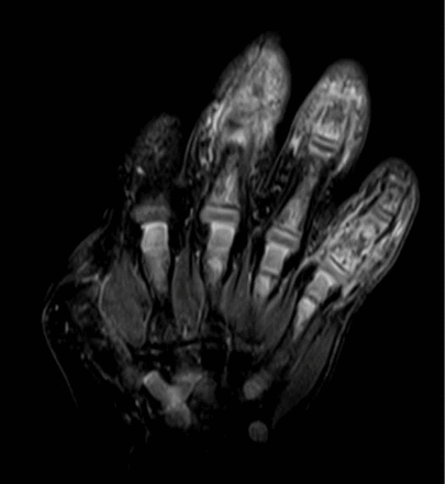 Coronal T2-weighted fat suppressed MRI of the right hand showing diffuse marrow oedema of the involved phalanges and intramedullary lytic areas with extensive surrounding soft-tissue inflammation.