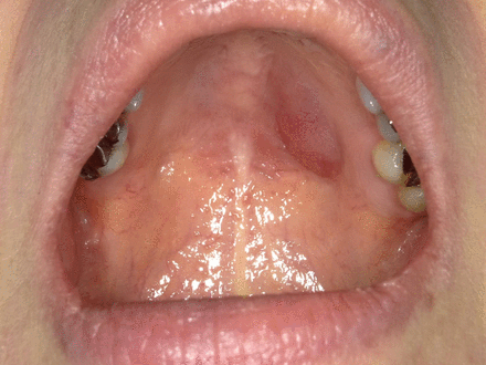 Intraoral photograph showing a non-ulcerative mass in the left side of the hard palate measuring 23×12 mm in size.