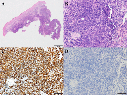 Histopathological examination with H&E and immunohistochemical staining. (A) Low-power view showing diffuse, unencapsulated, cellular infiltration of the submucosal stroma (H&E ×40). (B) High-power view showing diffuse monotonous cellular lymphoid infiltrate inconsistent with an inflammatory infiltrate (H&E ×200). (C) Atypical lymphoid infiltrate showing positive immunoexpression for CD20, indicative of an exclusively B cell proliferation (immunohistochemical ×200). (D) Dense infiltrate of B cells with negative immunoexpression for EBV-encoded small RNA in situ hybridisation (×200). EBV, Epstein-Barr virus.