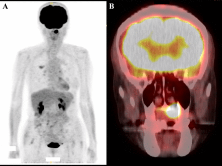 Fluorodeoxyglucose (FDG)-positron emission tomography/CT showing pathological uptake of FDG only in the left palate ((A) whole body, (B) craniomaxillofacial region).