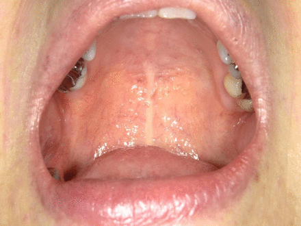 Intraoral photograph showing disappearance of the mass.