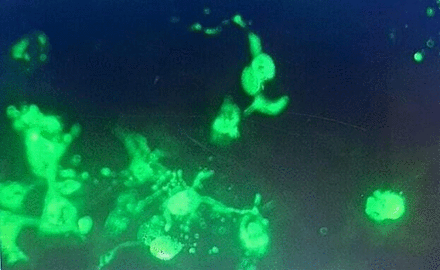 Immunostaining with fluorescein-labelled green dye of cerebrospinal fluid showing green-coloured antigen-antibody complex in dark background of non-reactive cells showing positive N-methyl-D-aspartate receptor antibodies.
