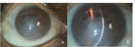 (A, B) At the final review; right eye showed a nebulo-macular corneal scar involving the visual axis and no anterior chamber activity was noted.