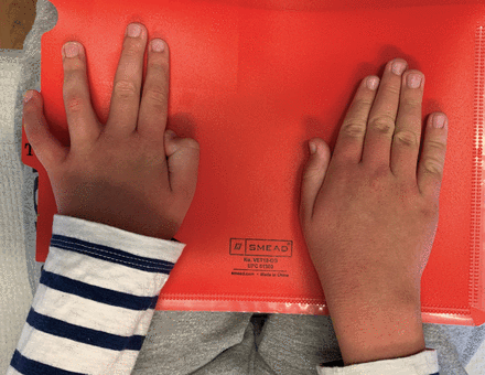 Preoperative clinical examination showing positive Wartenberg’s and Froment’s sign in the left hand.