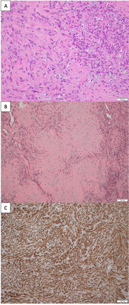 Histopathological images. (A) Hypercellular areas show ovoid and short spindle cells (H&E stain, scale bar=50 mm). (B) Nodular hypocellular areas show foci of stroma chondromyxoid-like changes as well as hyalinisation (H&E stain, scale bar=100 mm). (C) Immunohistochemistry with diffuse positive staining for SMA (SMA stain, scale bar=100 mm). SMA, smooth muscle actin.
