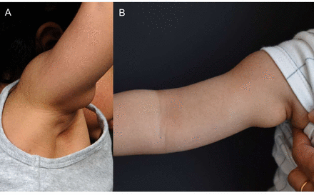 (A, B) Initial presentation of the female toddler demonstrating a pulsatile tumour on the upper right arm.