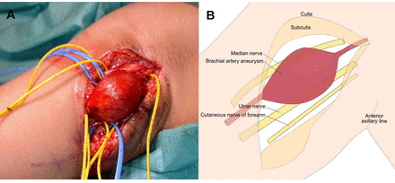 (A, B) Intraoperative view of the aneurysm after meticulous preparation of neighbouring veins and nerves that are marked with vessel loops. From cranial to caudal, the median nerve, ulnar nerve and cutaneous nerve of the forearm. Line diagram explaining the anatomy. The line diagram was created by the principal author of the case report.