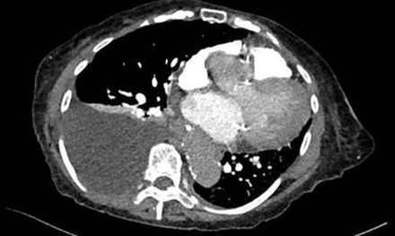 CT scan shoring pleural effusion.