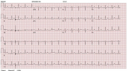 ECG day 2 after cessation of propofol and treatment with insulin/dextrose infusion, showing sinus tachycardia with a heart rate of 111 beats per minute.