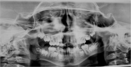 Orthopantomagram (OPG) showing dental status of the patient.