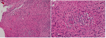 H&E stained biopsy of ileocecal valve lesions (40× image on left, 100× image on right) showing epitheloid cell granulomas with Langhans-type giant cells and caseous necrosis along with dense lymphoplasmacytic infiltrate in the background.