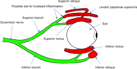 We speculate the presenting ptosis to be due to inflammation over the superior ramus of the cranial nerve III (which innervates the levator palpebrae superioris (LPS) and the superior rectus muscles), distal to the branch innervating the superior rectus muscle; this would explain the full function of the superior rectus muscle. (Figure created by MOM—corresponding author.)
