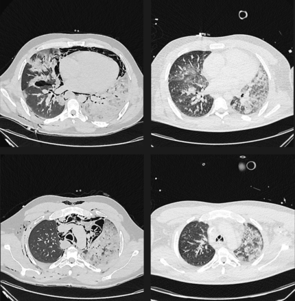 Axial chest CT images without intravenous contrast from admission (left two images) and with intravenous contrast after 7 days (right two images). Air surrounding the heart and great vessels diminishes over time.