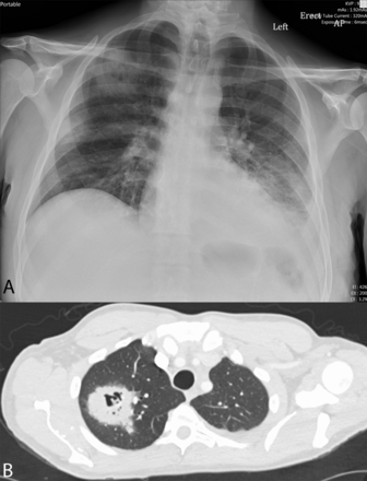(A and B) The chest radiograph at time of initial presentation (A) demonstrating the cavitary mass in the right upper lobe measuring about 5.2 cm in diameter, left lower lobe consolidation and small left pleural effusion. CT imaging of the chest (B) confirming cavitary lesion. Official read also commented on mass-like nature of the lesion and elevated concern for likely atypical infectious or inflammatory aetiology.
